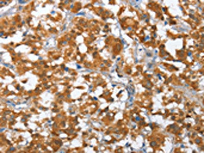 The image on the left is immunohistochemistry of paraffin-embedded Human thyroid cancer tissue using the antibody Antibody) at dilution 1/35, on the right is treated with fusion protein. (Original magnification: ×200)Rabbit anti-Human TP53BP2 Polyclonal Antibody