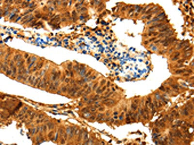 The image on the left is immunohistochemistry of paraffin-embedded Human colon cancer tissue using PARK7 Antibody(PARK7 Antibody) at dilution 1/25, on the right is treated with fusion protein. (Original magnification: ×200)Rabbit anti-Human PARK7 Polyclonal Antibody
