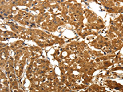 The image on the left is immunohistochemistry of paraffin-embedded Human lung cancer  tissue using the antibody Antibody) at dilution 1/25, on the right is treated with fusion protein. (Original magnification: ×200)Rabbit anti-Human PARK7 Polyclonal Antibody