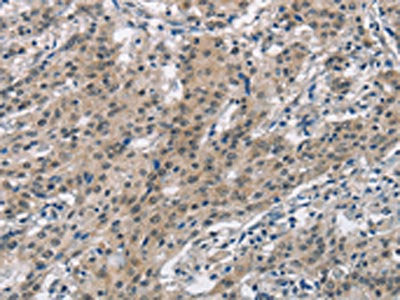 The image on the left is immunohistochemistry of paraffin-embedded Human gastric cancer tissue using SMAD9 Antibody(SMAD9 Antibody) at dilution 1/30, on the right is treated with synthetic peptide. (Original magnification: ×200)Rabbit anti-Human SMAD9 Polyclonal Antibody