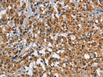 The image on the left is immunohistochemistry of paraffin-embedded Human thyroid cancer tissue using the antibody Antibody) at dilution 1/30, on the right is treated with synthetic peptide. (Original magnification: ×200)Rabbit anti-Human SMAD9 Polyclonal Antibody