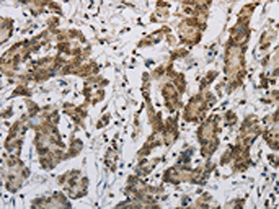 The image on the left is immunohistochemistry of paraffin-embedded Human colon cancer tissue using HIST1H2AB Antibody(HIST1H2AB Antibody) at dilution 1/30, on the right is treated with synthetic peptide. (Original magnification: ×200)Rabbit anti-Human HIST1H2AB Polyclonal Antibody