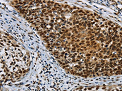 The image on the left is immunohistochemistry of paraffin-embedded Human cervical cancer tissue using the antibody Antibody) at dilution 1/30, on the right is treated with synthetic peptide. (Original magnification: ×200)Rabbit anti-Human HIST1H2AB Polyclonal Antibody