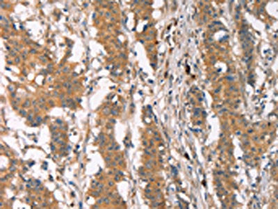The image on the left is immunohistochemistry of paraffin-embedded Human gastric cancer tissue using PLIN2 Antibody(PLIN2 Antibody) at dilution 1/30, on the right is treated with synthetic peptide. (Original magnification: X200)Rabbit anti-Human PLIN2 Polyclonal Antibody