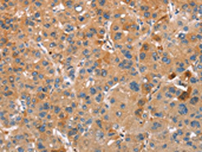 The image on the left is immunohistochemistry of paraffin-embedded Human liver cancer tissue using the antibody Antibody) at dilution 1/30, on the right is treated with synthetic peptide. (Original magnification: X200)Rabbit anti-Human PLIN2 Polyclonal Antibody