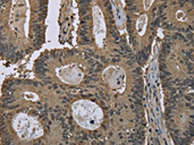 The image on the left is immunohistochemistry of paraffin-embedded Human colon cancer tissue using GSTP1 Antibody(GSTP1 Antibody) at dilution 1/60, on the right is treated with fusion protein. (Original magnification: ×200)Rabbit anti-Human GSTP1 Polyclonal Antibody