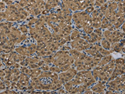 The image on the left is immunohistochemistry of paraffin-embedded Human thyroid cancer tissue using the antibody Antibody) at dilution 1/60, on the right is treated with fusion protein. (Original magnification: ×200)Rabbit anti-Human GSTP1 Polyclonal Antibody