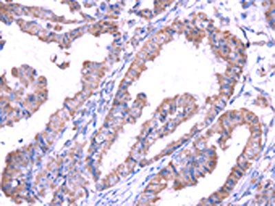 The image on the left is immunohistochemistry of paraffin-embedded Human esophagus cancer tissue using SRPK1 Antibody(SRPK1 Antibody) at dilution 1/45, on the right is treated with fusion protein. (Original magnification: ×200)Rabbit anti-Human SRPK1 Polyclonal Antibody
