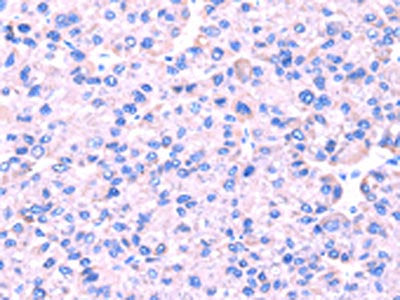 The image on the left is immunohistochemistry of paraffin-embedded Human liver cancer tissue using the antibody Antibody) at dilution 1/45, on the right is treated with fusion protein. (Original magnification: ×200)Rabbit anti-Human SRPK1 Polyclonal Antibody