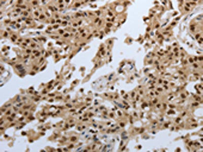 The image on the left is immunohistochemistry of paraffin-embedded Human lung cancer tissue using SMAD7 Antibody(SMAD7 Antibody) at dilution 1/60, on the right is treated with synthetic peptide. (Original magnification: ×200)Rabbit anti-Human SMAD7 Polyclonal Antibody