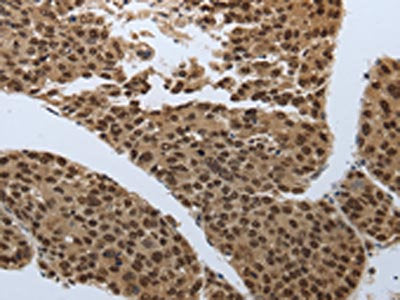 The image on the left is immunohistochemistry of paraffin-embedded Human liver cancer tissue using the antibody Antibody) at dilution 1/60, on the right is treated with synthetic peptide. (Original magnification: ×200)Rabbit anti-Human SMAD7 Polyclonal Antibody