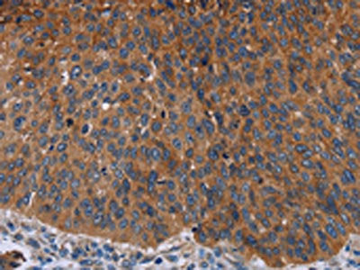 The image on the left is immunohistochemistry of paraffin-embedded Human lung cancer tissue using JUP Antibody(JUP Antibody) at dilution 1/50, on the right is treated with fusion protein. (Original magnification: ×200)