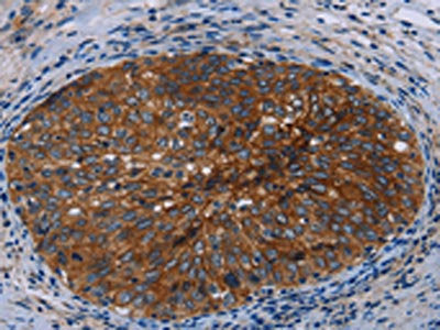 The image on the left is immunohistochemistry of paraffin-embedded Human cervical cancer tissue using the antibody Antibody) at dilution 1/50, on the right is treated with fusion protein. (Original magnification: ×200)