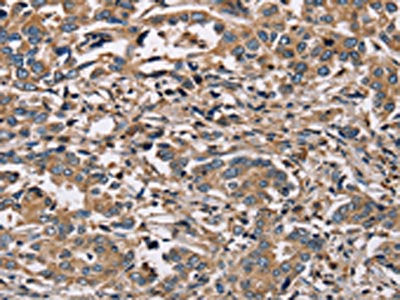 The image on the left is immunohistochemistry of paraffin-embedded Human liver cancer tissue using HSD17B12 Antibody(HSD17B12 Antibody) at dilution 1/30, on the right is treated with fusion protein. (Original magnification: ×200)Rabbit anti-Human HSD17B12 Polyclonal Antibody
