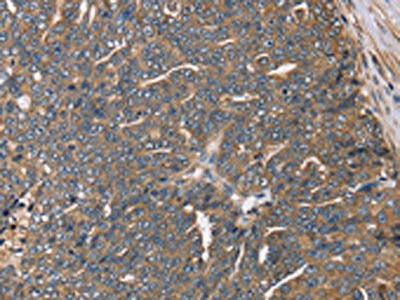 The image on the left is immunohistochemistry of paraffin-embedded Human cervical cancer tissue using the antibody Antibody) at dilution 1/30, on the right is treated with fusion protein. (Original magnification: ×200)Rabbit anti-Human HSD17B12 Polyclonal Antibody