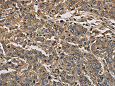 The image on the left is immunohistochemistry of paraffin-embedded Human liver cancer tissue using KIF22 Antibody(KIF22 Antibody) at dilution 1/30, on the right is treated with synthetic peptide. (Original magnification: ×200)Rabbit anti-Human KIF22 Polyclonal Antibody