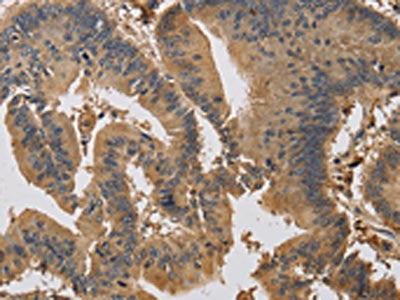 The image on the left is immunohistochemistry of paraffin-embedded Human colon cancer tissue using the antibody Antibody) at dilution 1/30, on the right is treated with synthetic peptide. (Original magnification: ×200)Rabbit anti-Human KIF22 Polyclonal Antibody