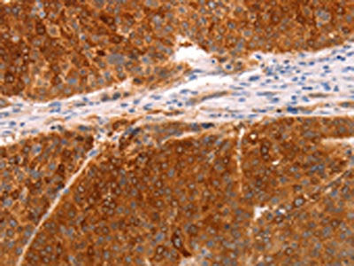 The image on the left is immunohistochemistry of paraffin-embedded Human liver cancer tissue using DCT Antibody(DCT Antibody) at dilution 1/25, on the right is treated with fusion protein. (Original magnification: ×200)Rabbit anti-Human DCT Polyclonal Antibody