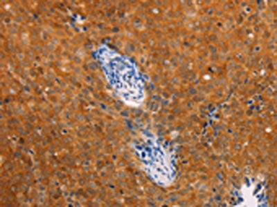 The image on the left is immunohistochemistry of paraffin-embedded Human cervical cancer tissue using the antibody Antibody) at dilution 1/25, on the right is treated with fusion protein. (Original magnification: ×200)Rabbit anti-Human DCT Polyclonal Antibody