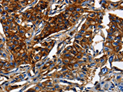The image on the left is immunohistochemistry of paraffin-embedded Human lung cancer tissue using ABCC5 Antibody(ABCC5 Antibody) at dilution 1/50, on the right is treated with synthetic peptide. (Original magnification: X200)