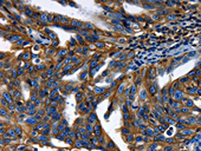 The image on the left is immunohistochemistry of paraffin-embedded Human ovarian cancer tissue using the antibody Antibody) at dilution 1/50, on the right is treated with synthetic peptide. (Original magnification: X200)
