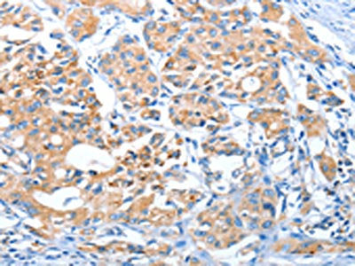 The image on the left is immunohistochemistry of paraffin-embedded Human lung cancer tissue using AUP1 Antibody(AUP1 Antibody) at dilution 1/50, on the right is treated with fusion protein. (Original magnification: ×200)