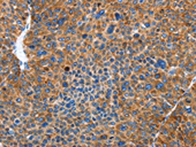 The image on the left is immunohistochemistry of paraffin-embedded Human liver cancer tissue using the antibody Antibody) at dilution 1/50, on the right is treated with fusion protein. (Original magnification: ×200)
