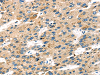 The image on the left is immunohistochemistry of paraffin-embedded Human liver cancer tissue using SENP8 Antibody(SENP8 Antibody) at dilution 1/40, on the right is treated with fusion protein. (Original magnification: ×200)