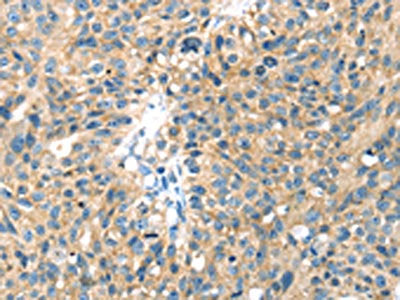 The image on the left is immunohistochemistry of paraffin-embedded Human breast cancer tissue using the antibody Antibody) at dilution 1/40, on the right is treated with fusion protein. (Original magnification: ×200)