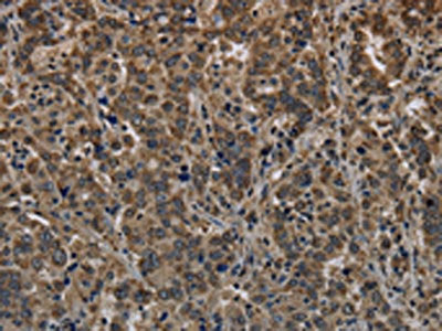 The image on the left is immunohistochemistry of paraffin-embedded Human liver cancer tissue using HIST1H4A Antibody(HIST4H4 Antibody) at dilution 1/20, on the right is treated with fusion protein. (Original magnification: ×200)Rabbit anti-Human HIST1H4A Polyclonal Antibody
