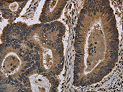 The image on the left is immunohistochemistry of paraffin-embedded Human colon cancer tissue using the antibody Antibody) at dilution 1/20, on the right is treated with fusion protein. (Original magnification: ×200)Rabbit anti-Human HIST1H4A Polyclonal Antibody
