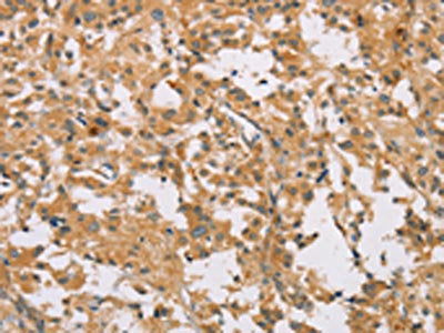 The image on the left is immunohistochemistry of paraffin-embedded Human thyroid cancer tissue using CDCP1 Antibody(CDCP1 Antibody) at dilution 1/50, on the right is treated with synthetic peptide. (Original magnification: ×200)Rabbit anti-Human CDCP1 Polyclonal Antibody