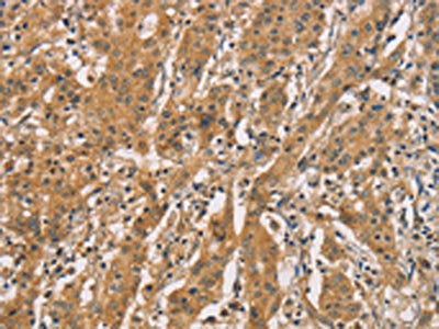 The image on the left is immunohistochemistry of paraffin-embedded Human gastic cancer tissue using the antibody Antibody) at dilution 1/50, on the right is treated with synthetic peptide. (Original magnification: ×200)Rabbit anti-Human CDCP1 Polyclonal Antibody