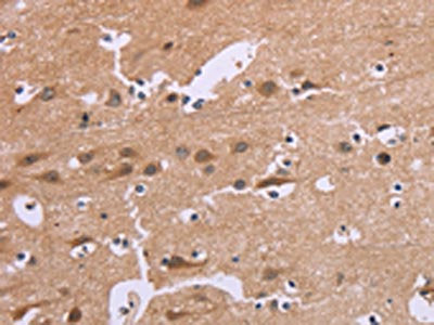 The image on the left is immunohistochemistry of paraffin-embedded Human brain tissue using CDK1 Antibody(CDK1 Antibody) at dilution 1/20, on the right is treated with synthetic peptide. (Original magnification: ×200)Rabbit anti-Human CDK1 Polyclonal Antibody