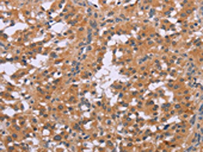 The image on the left is immunohistochemistry of paraffin-embedded Human thyroid cancer tissue using the antibody Antibody) at dilution 1/20, on the right is treated with synthetic peptide. (Original magnification: ×200)Rabbit anti-Human CDK1 Polyclonal Antibody