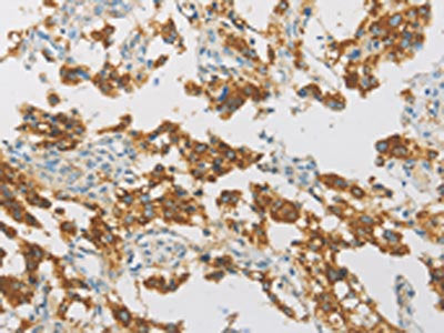 The image on the left is immunohistochemistry of paraffin-embedded Human thyroid cancer tissue using IDH3G Antibody(IDH3G Antibody) at dilution 1/30, on the right is treated with fusion protein. (Original magnification: ×200)Rabbit anti-Human IDH3G Polyclonal Antibody