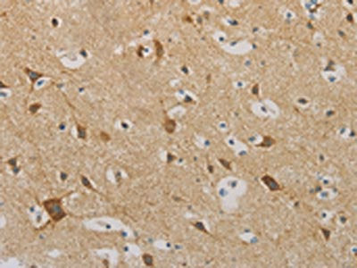 The image on the left is immunohistochemistry of paraffin-embedded Human brain tissue using the antibody Antibody) at dilution 1/30, on the right is treated with fusion protein. (Original magnification: ×200)Rabbit anti-Human IDH3G Polyclonal Antibody