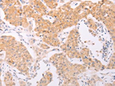 The image on the left is immunohistochemistry of paraffin-embedded Human lung cancer tissue using NFKBIE Antibody(NFKBIE Antibody) at dilution 1/40, on the right is treated with fusion protein. (Original magnification: ×200)Rabbit anti-Human NFKBIE Polyclonal Antibody