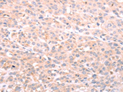 The image on the left is immunohistochemistry of paraffin-embedded Human esophagus cancer tissue using the antibody Antibody) at dilution 1/40, on the right is treated with fusion protein. (Original magnification: ×200)Rabbit anti-Human NFKBIE Polyclonal Antibody