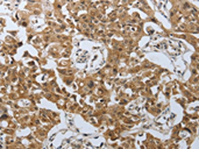 The image on the left is immunohistochemistry of paraffin-embedded Human lung cancer tissue using PSMD6 Antibody(PSMD6 Antibody) at dilution 1/40, on the right is treated with synthetic peptide. (Original magnification: ×200)Rabbit anti-Human PSMD6 Polyclonal Antibody