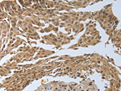 The image on the left is immunohistochemistry of paraffin-embedded Human cervical cancer tissue using the antibody Antibody) at dilution 1/40, on the right is treated with synthetic peptide. (Original magnification: ×200)Rabbit anti-Human PSMD6 Polyclonal Antibody