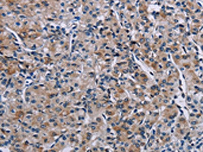 The image on the left is immunohistochemistry of paraffin-embedded Human prostate cancer tissue using KDM4D Antibody(KDM4D Antibody) at dilution 1/50, on the right is treated with fusion protein. (Original magnification: ×200)