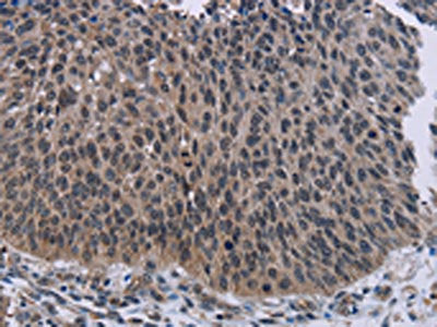 The image on the left is immunohistochemistry of paraffin-embedded Human lung cancer tissue using the antibody Antibody) at dilution 1/50, on the right is treated with fusion protein. (Original magnification: ×200)