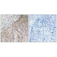 Immunohistochemistry analysis of paraffin-embedded human cervix carcinoma tissue using APOL2 antibody.Rabbit anti-Human APOL2 Polyclonal Antibody