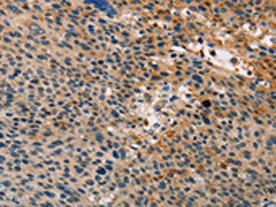 The image on the left is immunohistochemistry of paraffin-embedded Human liver cancer tissue using TLR1 Antibody(TLR1 Antibody) at dilution 1/20, on the right is treated with fusion protein. (Original magnification: ×200)Rabbit anti-Human TLR1 Polyclonal Antibody