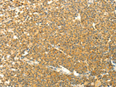 The image on the left is immunohistochemistry of paraffin-embedded Human lymphoma tissue using the antibody Antibody) at dilution 1/40, on the right is treated with fusion protein. (Original magnification: ×200)