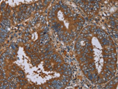 The image on the left is immunohistochemistry of paraffin-embedded Human colon cancer tissue using the antibody Antibody) at dilution 1/40, on the right is treated with fusion protein. (Original magnification: ×200)Rabbit anti-Human IL27RA Polyclonal Antibody