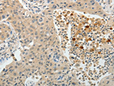 The image on the left is immunohistochemistry of paraffin-embedded Human lung cancer tissue using TEKT5 Antibody(TEKT5 Antibody) at dilution 1/40, on the right is treated with fusion protein. (Original magnification: ×200)Rabbit anti-Human TEKT5 Polyclonal Antibody