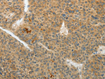 The image on the left is immunohistochemistry of paraffin-embedded Human liver cancer tissue using the antibody Antibody) at dilution 1/40, on the right is treated with fusion protein. (Original magnification: ×200)Rabbit anti-Human TEKT5 Polyclonal Antibody