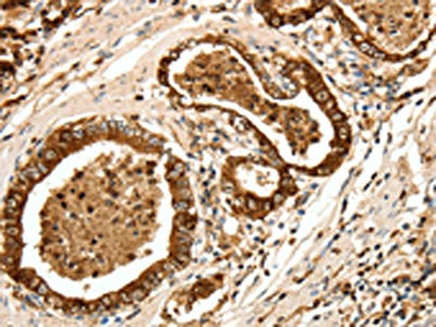 The image on the left is immunohistochemistry of paraffin-embedded Human gastric cancer tissue using LYZ Antibody(LYZ Antibody) at dilution 1/20, on the right is treated with fusion protein. (Original magnification: ×200)